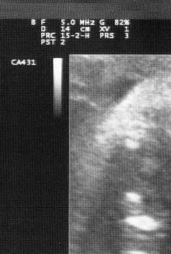 Mehemeloth : Infantile Defecation